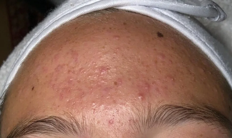 Forehead outlet pimples cause